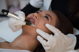 Microneedeling