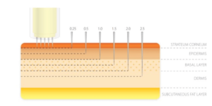 Microneedeling-Adancime Penetrare