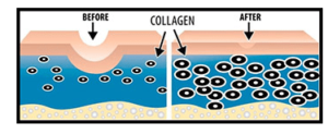 Microneedeling-Producere Colagen